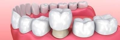 cerec crown going on prepped tooth