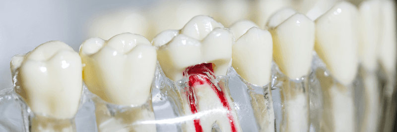 mockup of dental implants in northborough