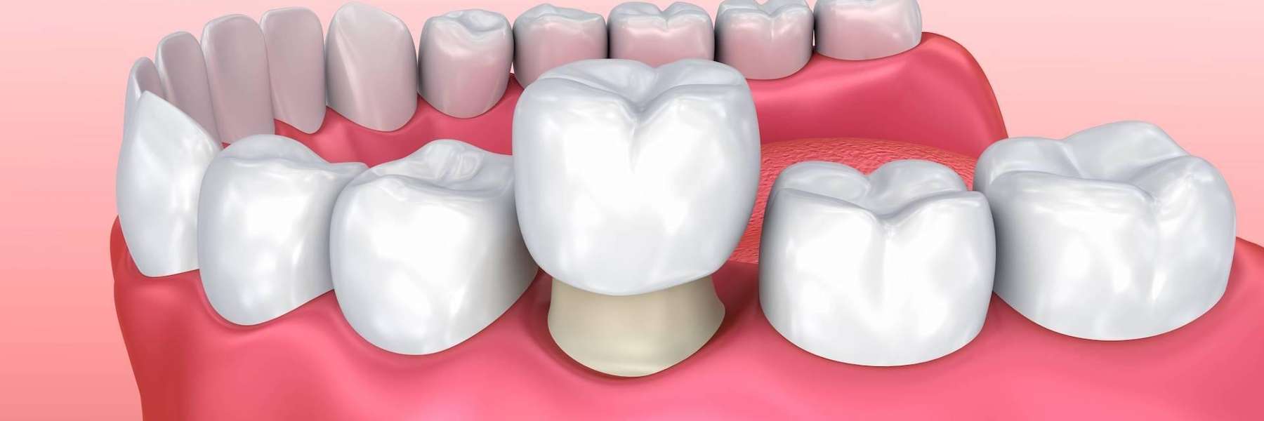 dental crown placed over a tooth in Northborough, MA