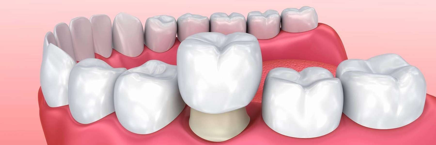 An image illustrating Dental Crown in Northborough, MA