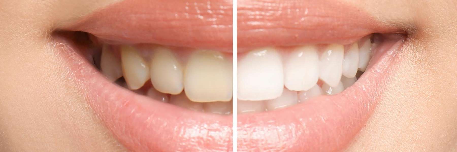 Teeth whitening effect in Northborough MA