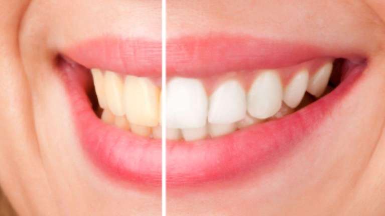 Teeth whitening before and after photo in Northborough MA