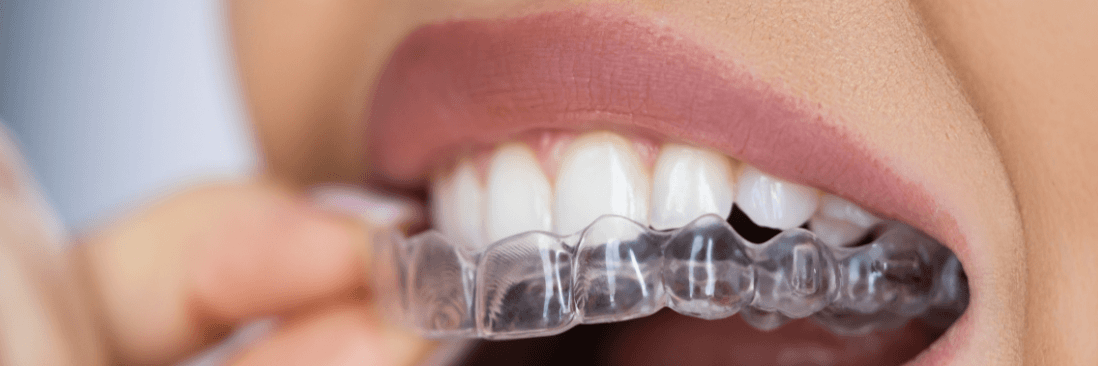 putting on clear aligners in Northborough, MA