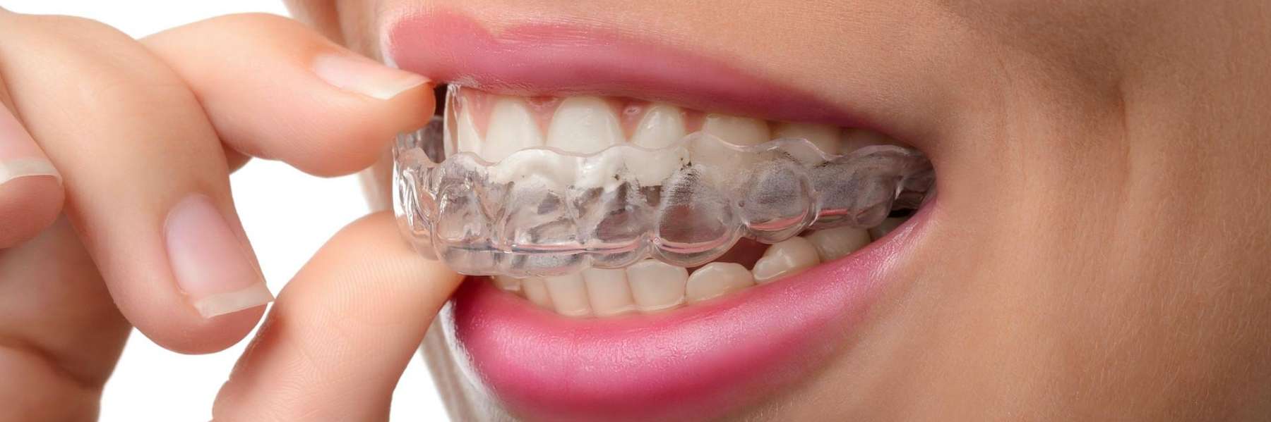 A close up photo of an Invisalign in Northborough, MA