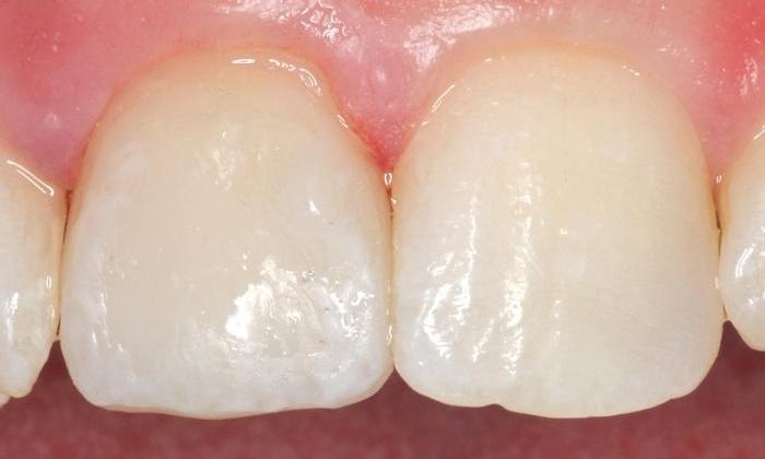 Close up of front tooth restored with crown