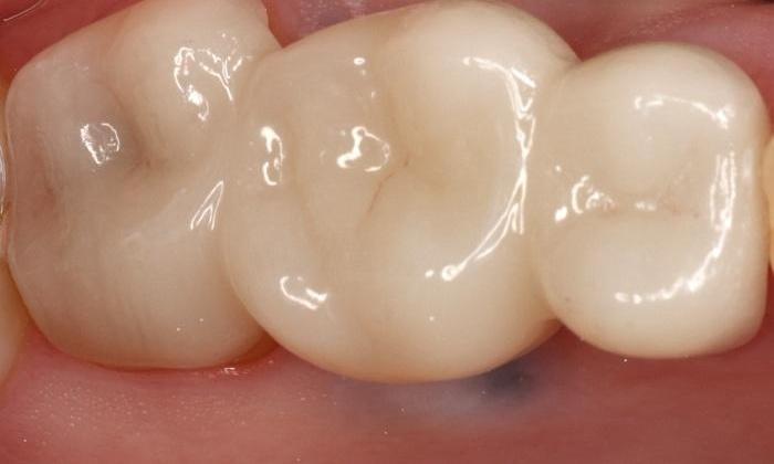 Restored broken tooth with bridge