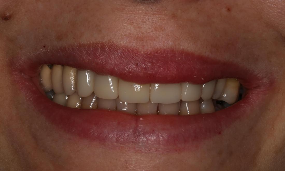 Close up of woman's smile after smile makeover