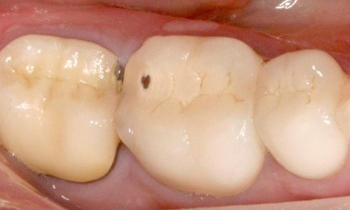 Close up of broken crown