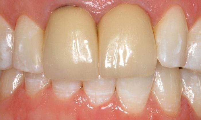 Dark front teeth