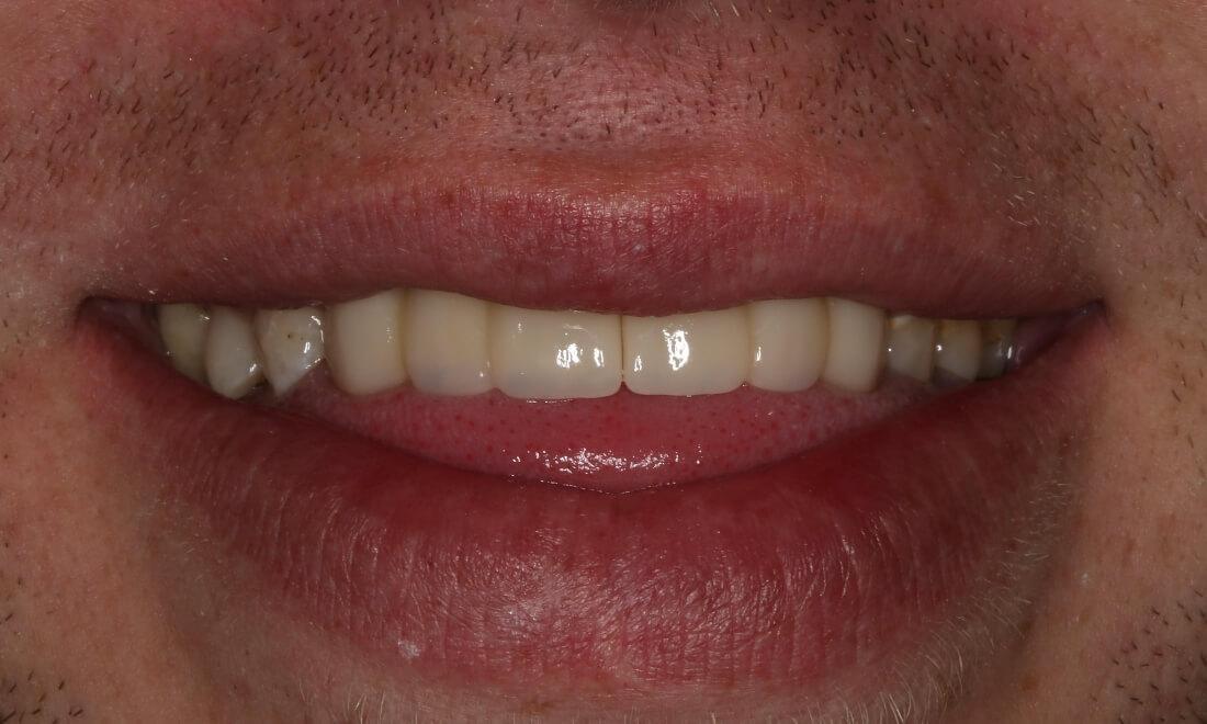 close up of patient's smile after smile makeover