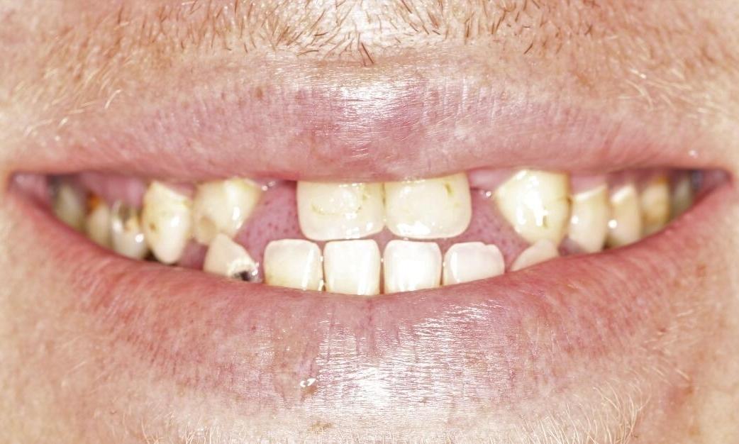 close up of smile with gaps in front teeth