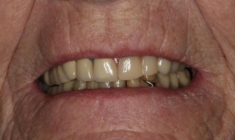 3D-Printed-Removable-Partial-Denture-After-Image