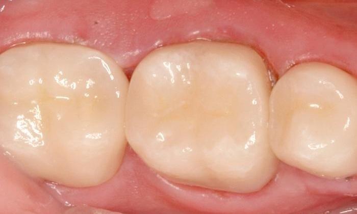 close up after new all-porcelain crown