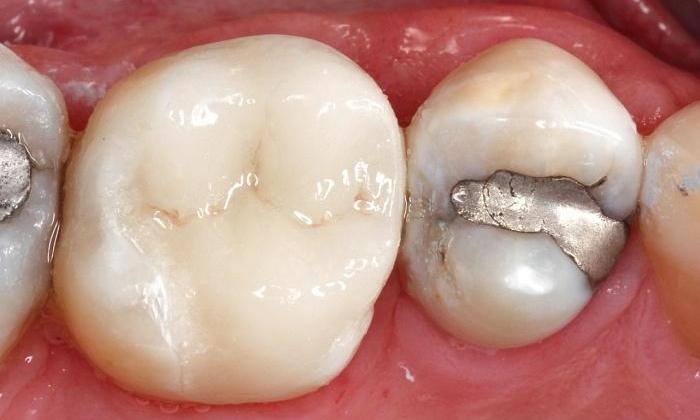 Broken fillings replaced with crown