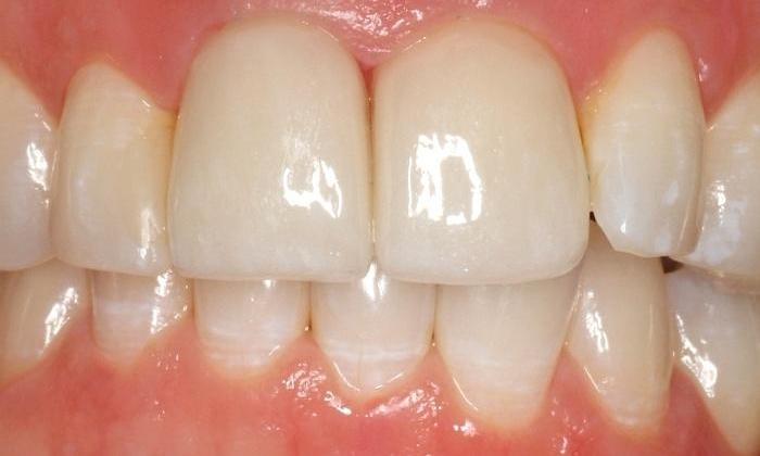 Dental crowns used to replace dark front teeth