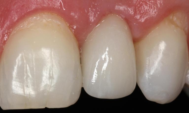 Dental-Implant-on-Front-Tooth-After-Image