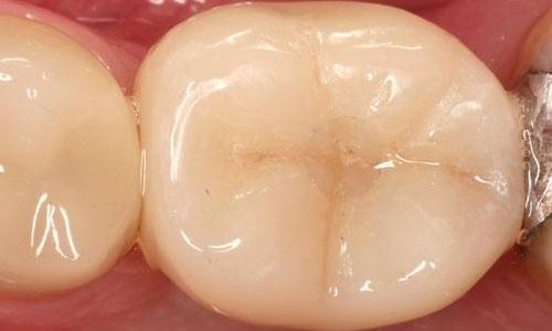 Dental-Implant-on-Back-Molar-After-Image