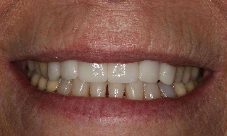 Close up of patient's teeth after invisalign and crown smile makeover