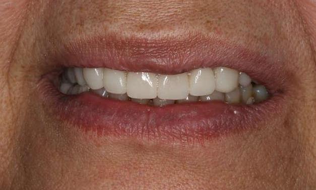 Close up of a patient's smile after cosmetic dentistry