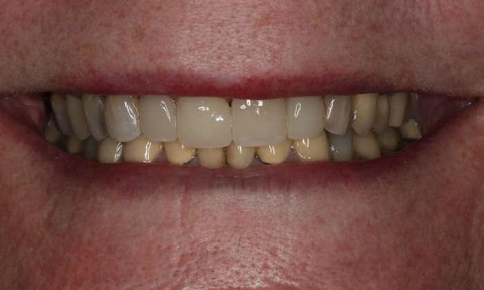 Close up of woman's smile after smile makeover