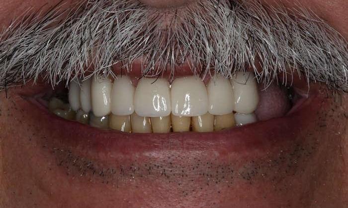 Close up of man's smile after cosmetic dentistry
