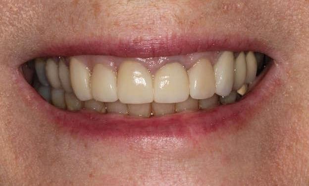 Close up of patient's smile after smile makeover