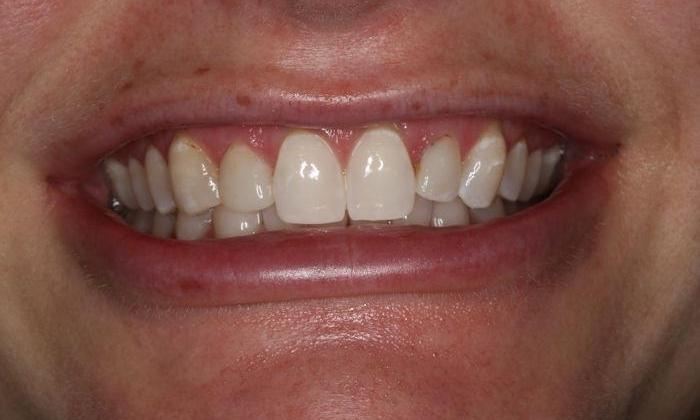 Close up of patient's smile after zoom whitening