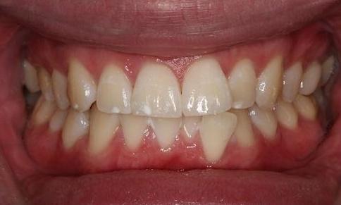 Close up of patient's bright smile after zoom whitening