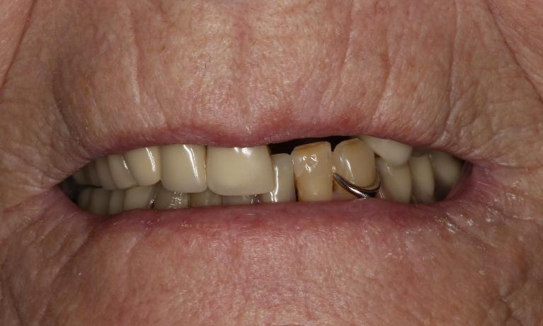 3D-Printed-Removable-Partial-Denture-Before-Image