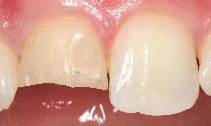 Close up of chipped tooth