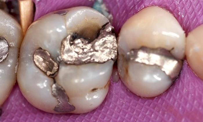 Broken silver fillings