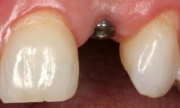 Dental-Implant-on-Front-Tooth-Before-Image