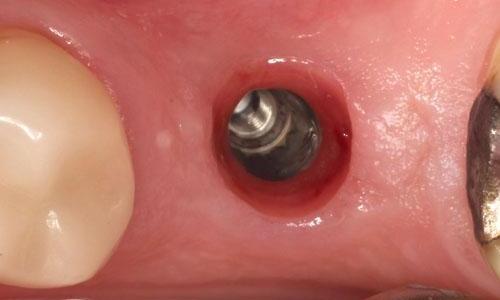 Dental-Implant-on-Back-Molar-Before-Image