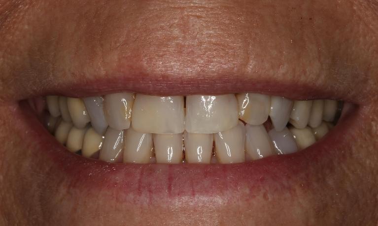 Close up of patient's teeth before smile makeoever