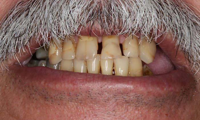 Close up of man's older, yellowed teeth
