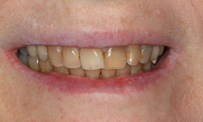Close up of patient's smile