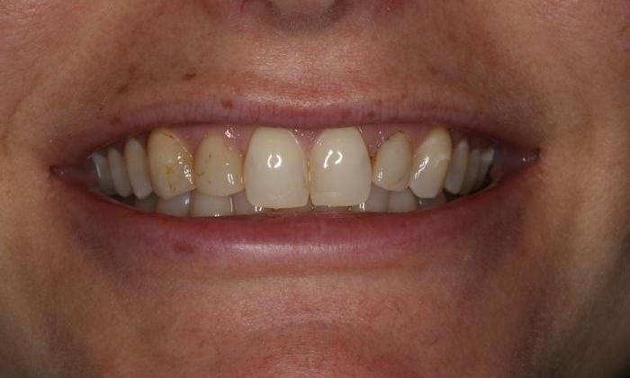 Close up of patient's smile before whitening