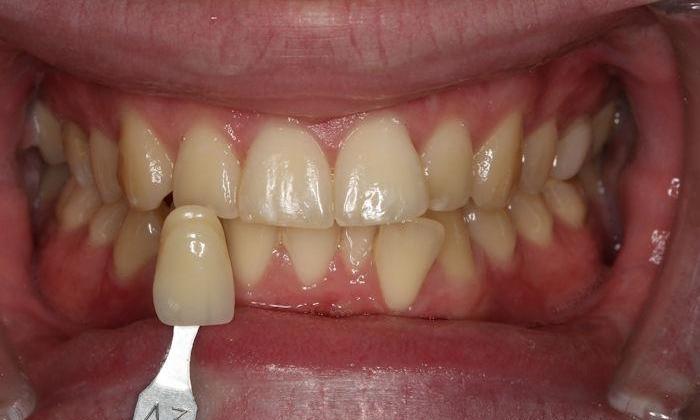 Close up of patient's smile before whitening